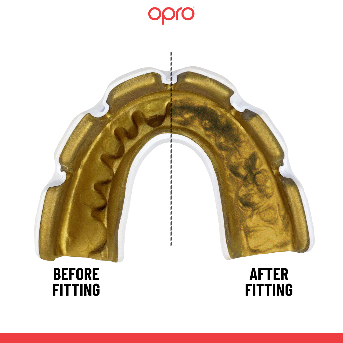 Instant Custom-Fit White Mouthguard for Braces