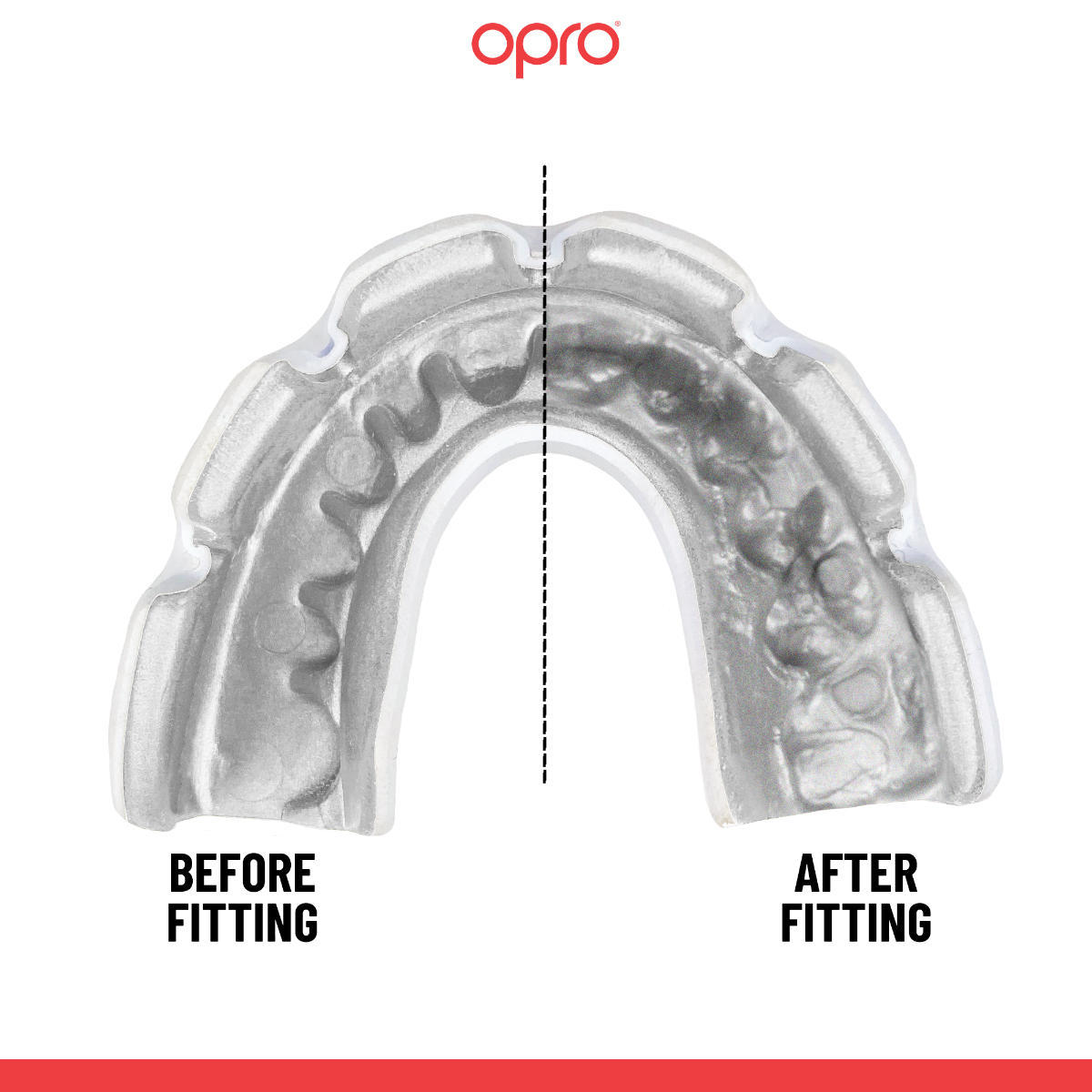 Instant Custom-Fit Clear Mouthguard for Braces