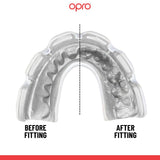 Instant Custom-Fit Clear Mouthguard for Braces