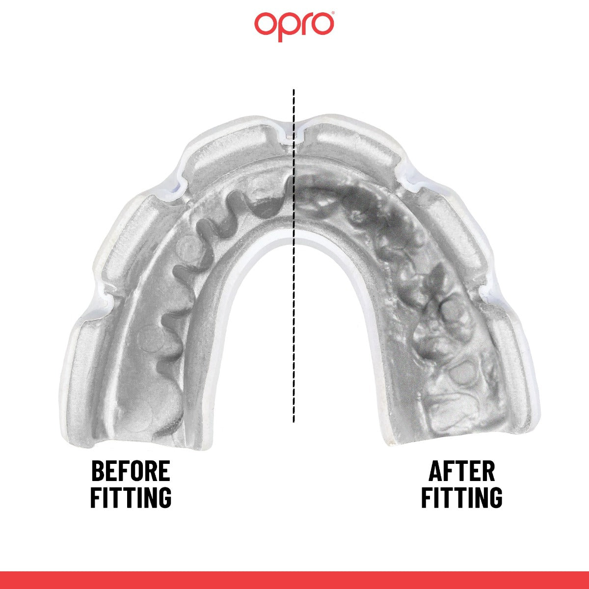 Instant Custom-Fit Clear Mouthguard for Braces
